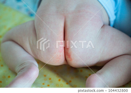 Red diaper rash on the pope of a baby from a diaper. Irritation on the delicate skin of an infant. Dermatitis 104432800