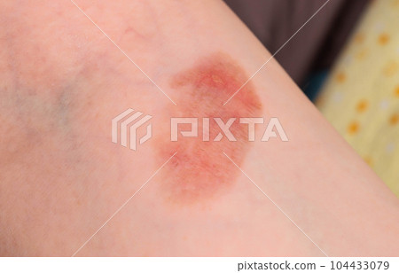 Red spot on the skin, skin damage from a burn on the arm. Close-up 104433079