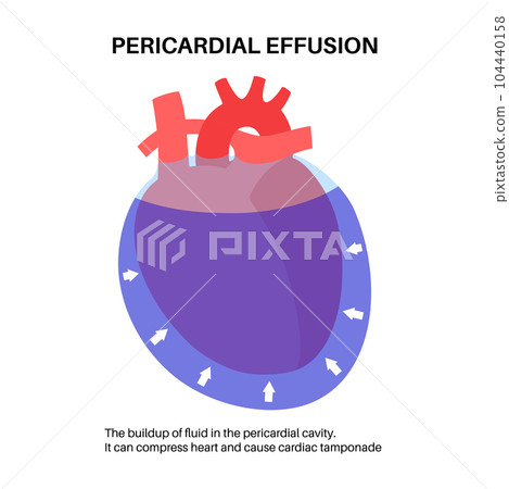 Pericardial effusion heart 104440158