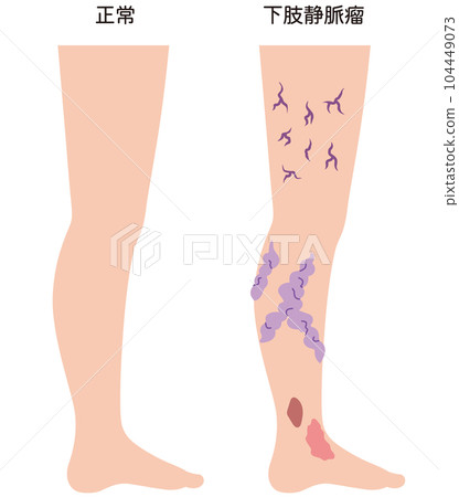 Lower extremity varicose vein disease medical care 104449073