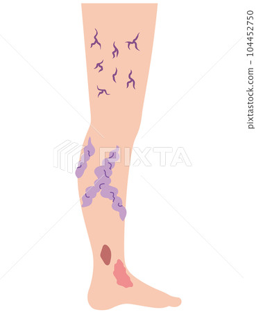 下肢靜脈曲張疾病醫療 104452750
