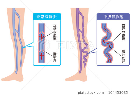 下肢靜脈曲張疾病醫療 下肢靜脈曲張疾病醫療 104453085