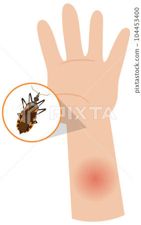 Human arm swollen from kissing bug bite 104453400