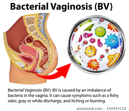 Bacterial Vaginosis infographic with explanation 104454118