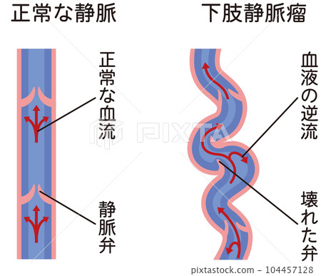 Lower extremity varicose vein disease medical care 104457128