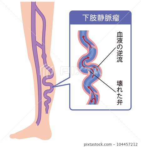 Lower extremity varicose vein disease medical care Lower extremity varicose vein disease medical care 104457212