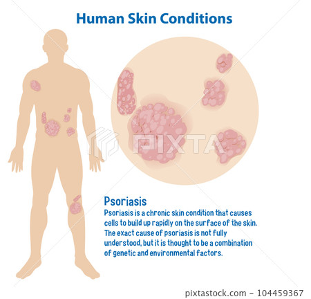 Human skin conditions infographic with explanation Human skin conditions infographic with explanation 104459367