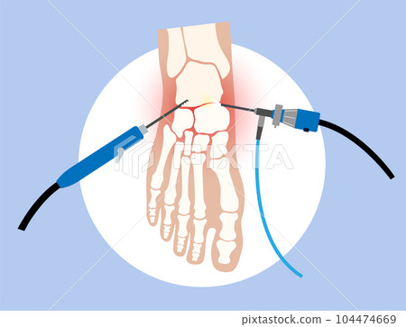 Ankle arthroscopy poster Ankle arthroscopy poster 104474669