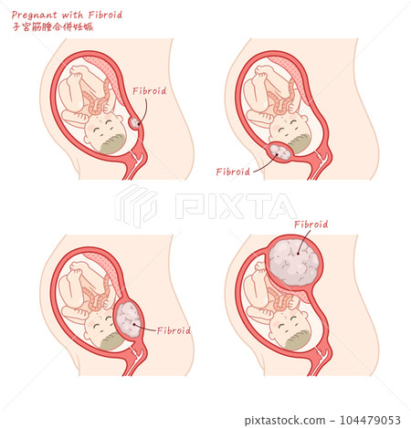 妊娠期肌瘤並發症 104479053