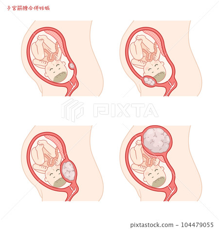 Illustration of pregnancy with fibroids, fibroids, pregnant, woman with fibroids Illustration of pregnancy with fibroids, fibroids, pregnant, woman with fibroids 104479055