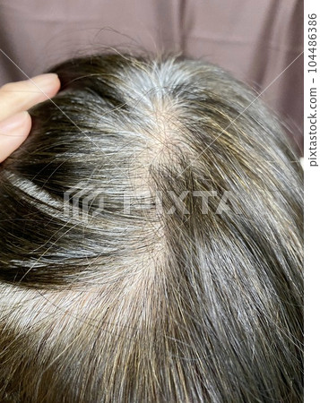 thin hair woman 104486386