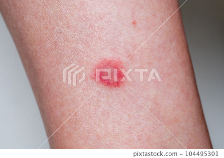 Man's leg bitten by a tick on a futon Man's leg bitten by a tick on a futon 104495301
