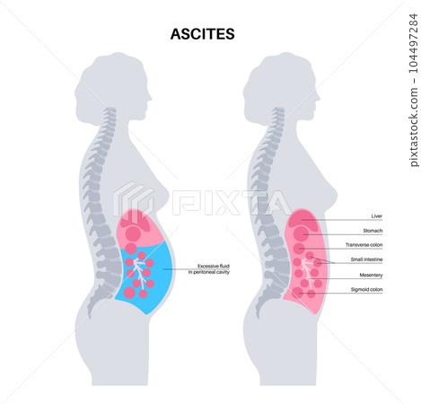 Ascites disease poster 104497284