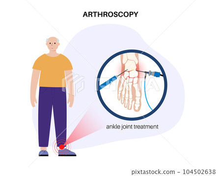 Ankle arthroscopy poster Ankle arthroscopy poster 104502638