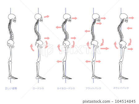 Skeleton set with bad posture seen from the side Skeleton set with bad posture seen from the side 104514845