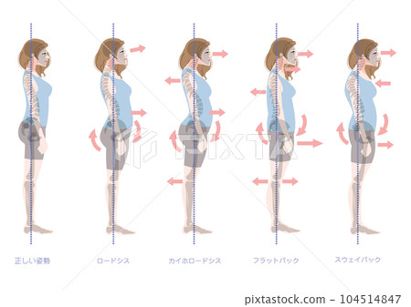 Bad posture female set seen from the side 104514847