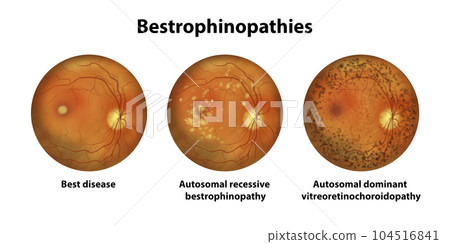 Bestrophinopathies, inherited retinal disorders caused by mutations in the BEST1 gene, illustration 104516841