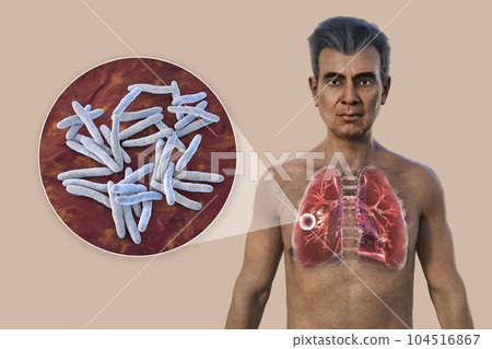 A 3D illustration of the upper half of a man with transparent skin, showcasing the lungs affected by cavernous tuberculosis, and close-up view of Mycobacterium tuberculosis bacteria 104516867