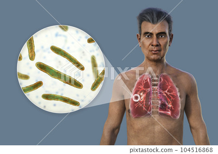 A 3D illustration of the upper half of a man with transparent skin, showcasing the lungs affected by cavernous tuberculosis, and close-up view of Mycobacterium tuberculosis bacteria A 3D illustration of the upper half of a man with transparent skin, showcasing the lungs affected by cavernous tuberculosis, and close-up view of Mycobacterium tuberculosis bacteria 104516868