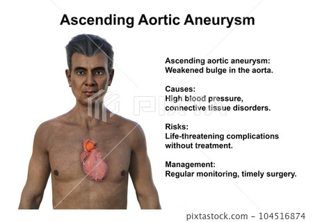 A 3D illustration of the upper half part of a senior man with transparent skin, revealing an ascending aortic aneurysm 104516874