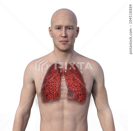 A 3D illustration of the upper half part of a man with transparent skin, revealing the condition of smoker's lungs A 3D illustration of the upper half part of a man with transparent skin, revealing the condition of smoker's lungs 104516884