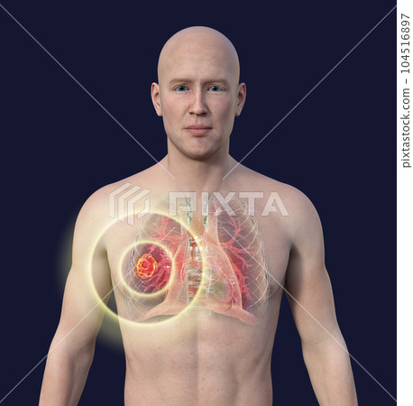 A 3D illustration of the upper half part of a man with transparent skin, revealing a lung mucormycosis lesion A 3D illustration of the upper half part of a man with transparent skin, revealing a lung mucormycosis lesion 104516897