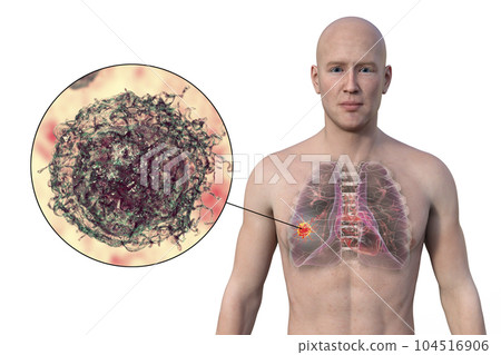 A 3D illustration of the upper half part of a man with transparent skin, revealing the presence of lung cancer A 3D illustration of the upper half part of a man with transparent skin, revealing the presence of lung cancer 104516906