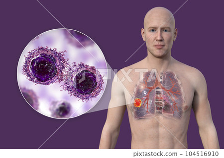 A 3D illustration of the upper half part of a man with transparent skin, revealing the presence of lung cancer A 3D illustration of the upper half part of a man with transparent skin, revealing the presence of lung cancer 104516910