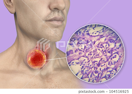 A 3D scientific illustration showcasing a man with transparent skin, revealing a tumor in his thyroid gland, along with a micrograph image of thyroid cancer. 104516925