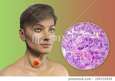 A 3D scientific illustration showcasing a woman with transparent skin, revealing a tumor in her thyroid gland, along with a micrograph image of thyroid cancer. 104516936