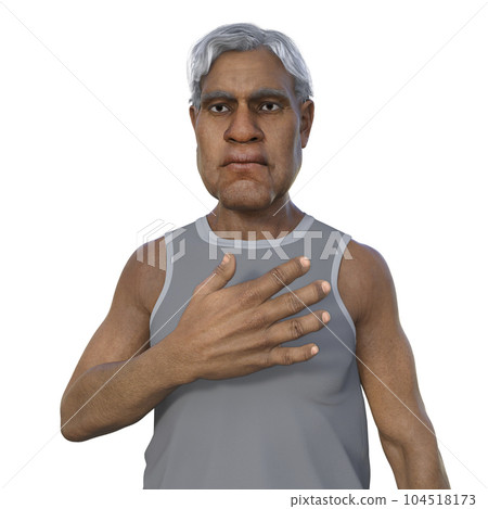 A man suffering from acromegaly, 3D illustration 104518173