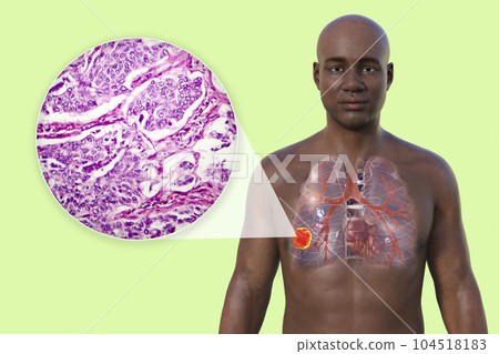 A 3D illustration of the upper half part of an African man with transparent skin, revealing the presence of lung cancer A 3D illustration of the upper half part of an African man with transparent skin, revealing the presence of lung cancer 104518183