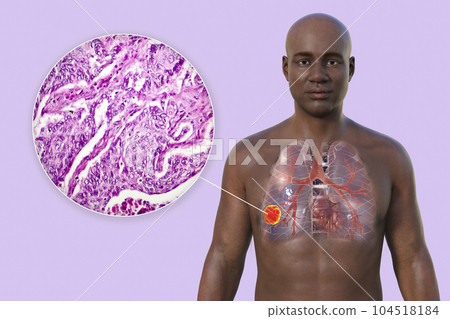 A 3D illustration of the upper half part of an African man with transparent skin, revealing the presence of lung cancer A 3D illustration of the upper half part of an African man with transparent skin, revealing the presence of lung cancer 104518184