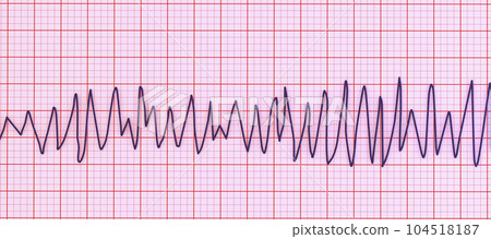 Electrocardiogram ECG displaying Torsades de pointes rhythm, 3D illustration 104518187