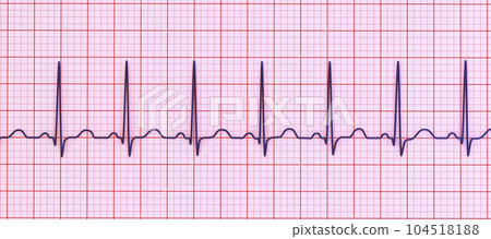 Electrocardiogram ECG displaying sinus tachycardia, 3D illustration 104518188