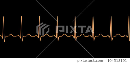 Electrocardiogram ECG displaying sinus tachycardia, 3D illustration Electrocardiogram ECG displaying sinus tachycardia, 3D illustration 104518191