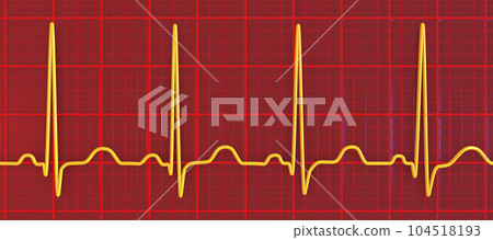 Electrocardiogram ECG displaying sinus tachycardia, 3D illustration 104518193