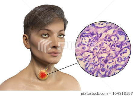A 3D scientific illustration showcasing a woman with transparent skin, revealing a tumor in her thyroid gland, along with a micrograph image of thyroid cancer. A 3D scientific illustration showcasing a woman with transparent skin, revealing a tumor in her thyroid gland, along with a micrograph image of thyroid cancer. 104518197