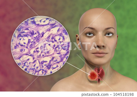 A 3D scientific illustration showcasing a woman with transparent skin, revealing a tumor in her thyroid gland, along with a micrograph image of thyroid cancer. A 3D scientific illustration showcasing a woman with transparent skin, revealing a tumor in her thyroid gland, along with a micrograph image of thyroid cancer. 104518198