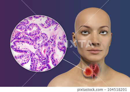 A 3D scientific illustration showcasing a woman with transparent skin, revealing a tumor in her thyroid gland, along with a micrograph image of thyroid cancer. 104518201
