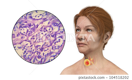 A 3D scientific illustration showcasing a woman with transparent skin, revealing a tumor in her thyroid gland, along with a micrograph image of thyroid cancer. A 3D scientific illustration showcasing a woman with transparent skin, revealing a tumor in her thyroid gland, along with a micrograph image of thyroid cancer. 104518202