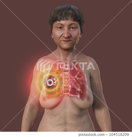 A 3D illustration of the upper half of a female patient with transparent skin, showcasing the lungs affected by cavernous tuberculosis 104518209