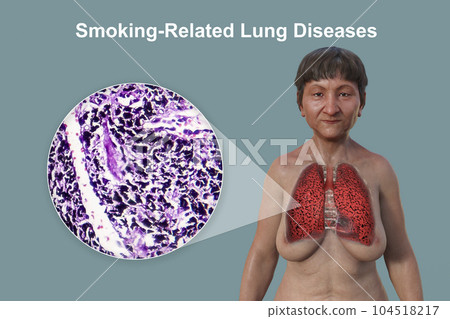 A 3D illustration of the upper half part of a female patient with transparent skin, revealing the condition of smoker's lungs A 3D illustration of the upper half part of a female patient with transparent skin, revealing the condition of smoker's lungs 104518217