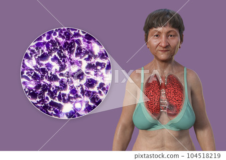 A 3D illustration of the upper half part of a female patient with transparent skin, revealing the condition of smoker's lungs A 3D illustration of the upper half part of a female patient with transparent skin, revealing the condition of smoker's lungs 104518219