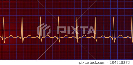 Electrocardiogram ECG displaying sinus tachycardia, 3D illustration 104518273