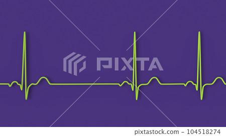 Electrocardiogram ECG displaying sinus arrhythmia, 3D illustration Electrocardiogram ECG displaying sinus arrhythmia, 3D illustration 104518274