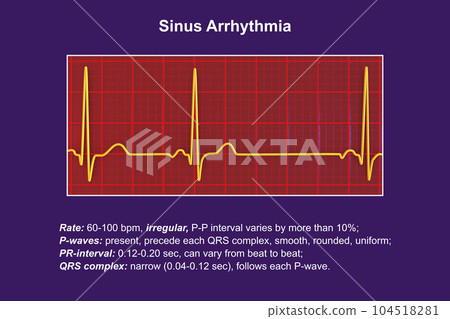 Electrocardiogram ECG displaying sinus arrhythmia, 3D illustration 104518281