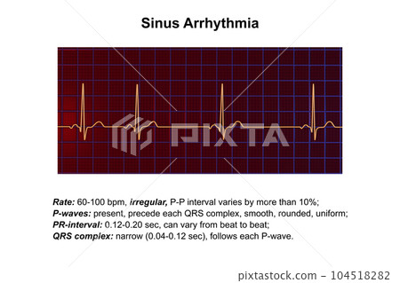 Electrocardiogram ECG displaying sinus arrhythmia, 3D illustration Electrocardiogram ECG displaying sinus arrhythmia, 3D illustration 104518282