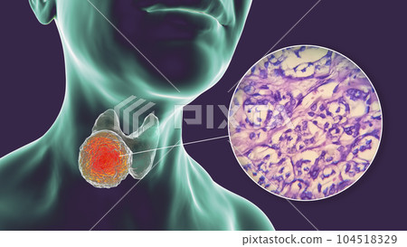 A 3D scientific illustration showcasing a human body with transparent skin, revealing a tumor in his thyroid gland, along with a micrograph image of thyroid cancer. A 3D scientific illustration showcasing a human body with transparent skin, revealing a tumor in his thyroid gland, along with a micrograph image of thyroid cancer. 104518329