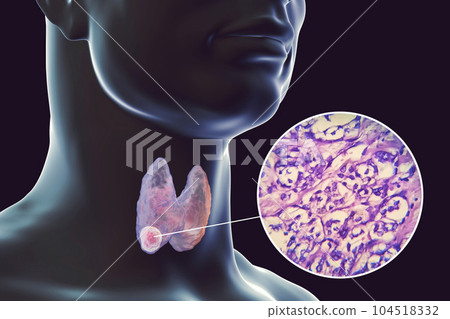 A 3D scientific illustration showcasing a human body with transparent skin, revealing a tumor in his thyroid gland, along with a micrograph image of thyroid cancer. A 3D scientific illustration showcasing a human body with transparent skin, revealing a tumor in his thyroid gland, along with a micrograph image of thyroid cancer. 104518332